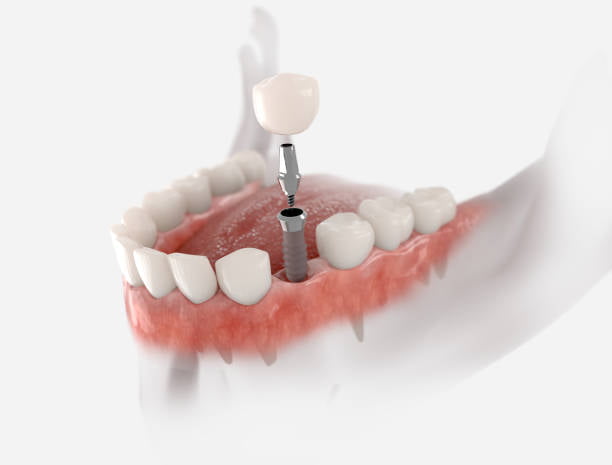 جراحة زراعة الأسنان : دليل شامل 2024