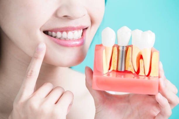 فوائد زراعة الأسنان