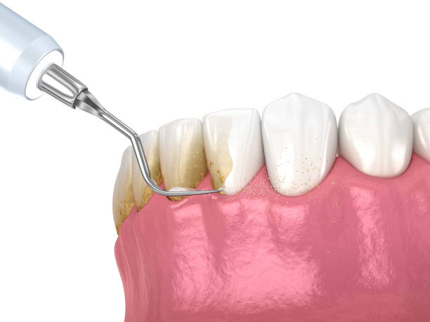جير الأسنان : الأسباب والأعراض وطرق العلاج | ديمه